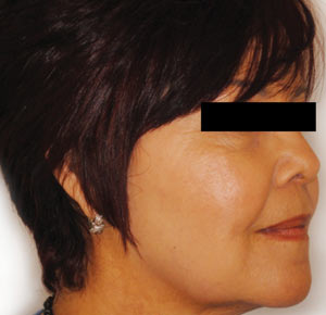 Skin Boosters - Anti Surgery System
